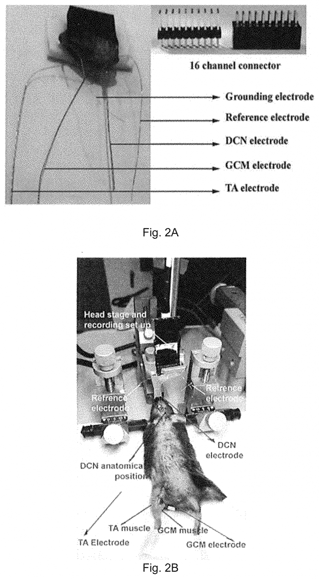 Neurostimulation System and Method for Modulating Abnormal Motor Movement