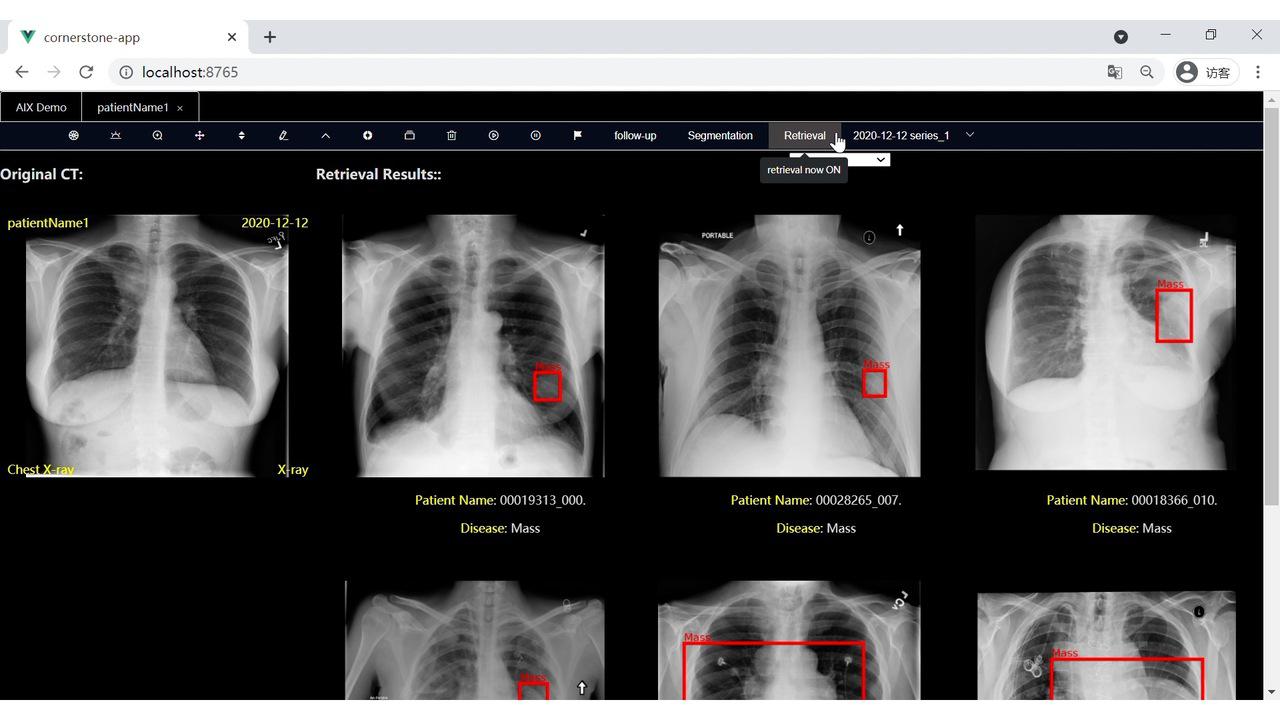 「AIX」Chest X-ray Screening with AI 0