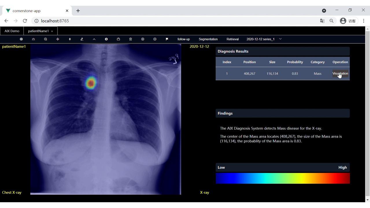 「AIX」Chest X-ray Screening with AI 1