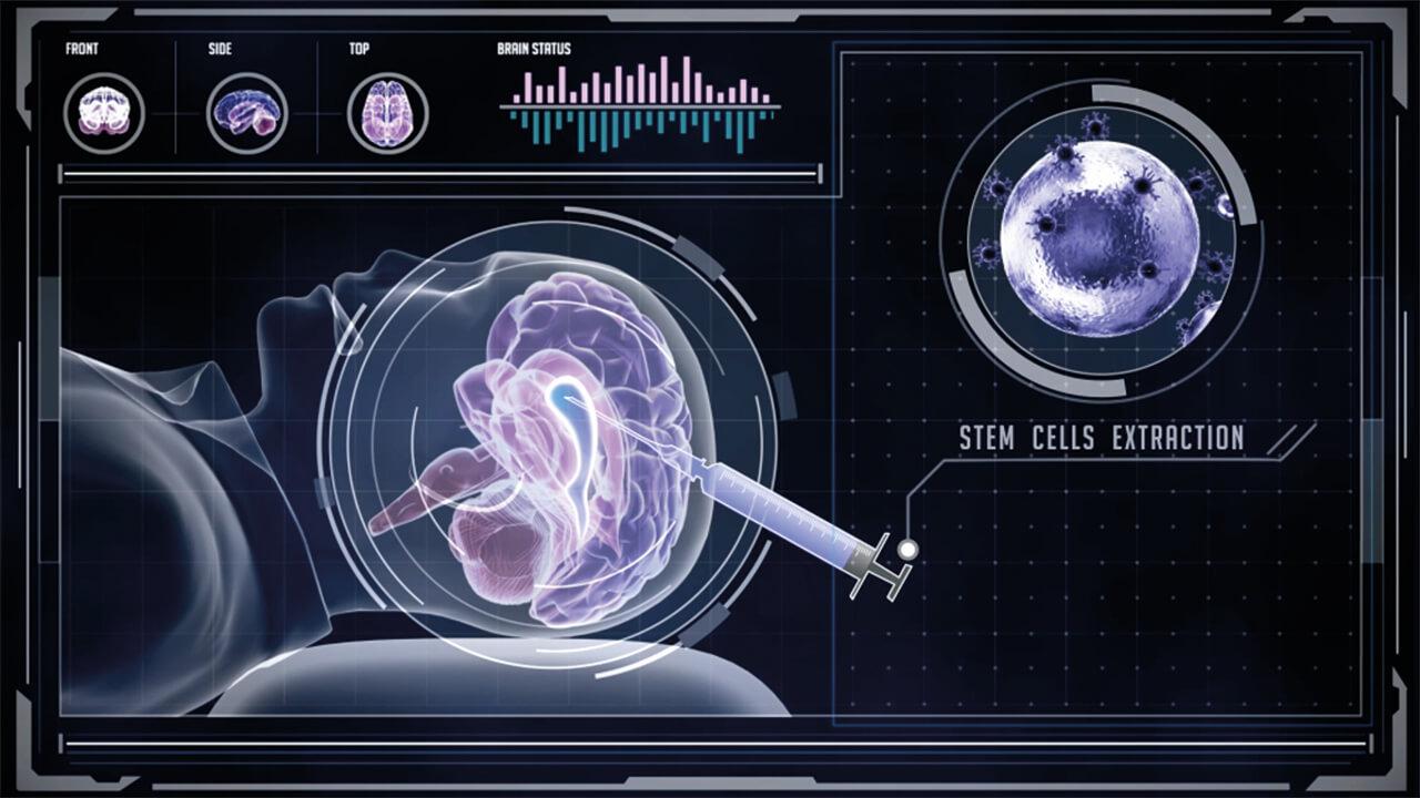 Extracting Autologous Neural Stem Cells for Treatment of Neurodegenerative Diseases