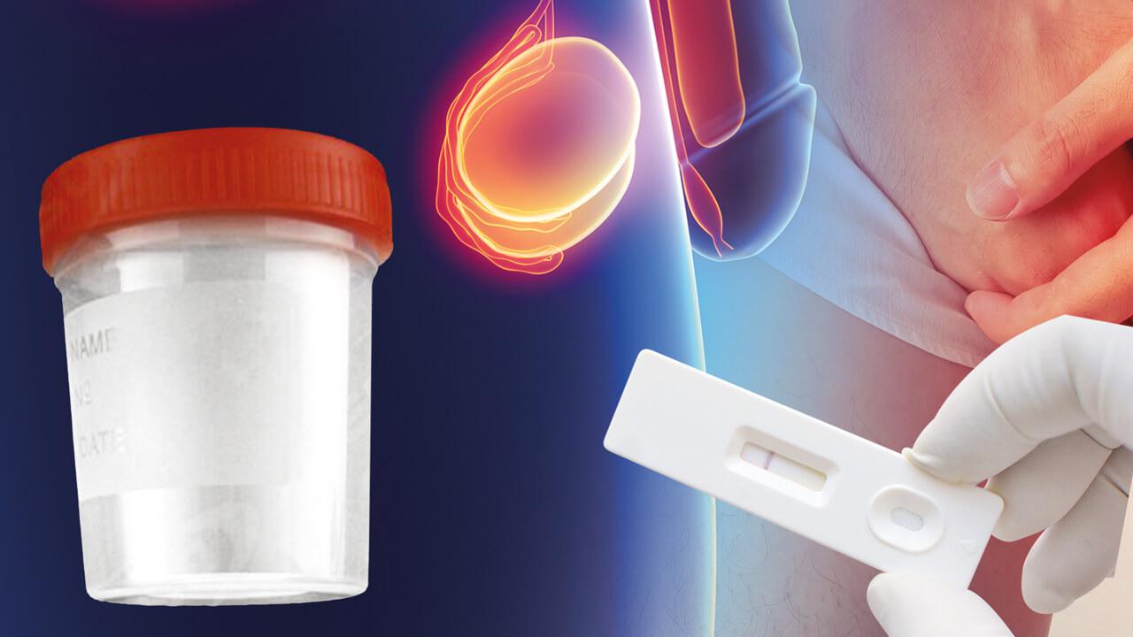 创新前列腺癌尿液检测试剂盒