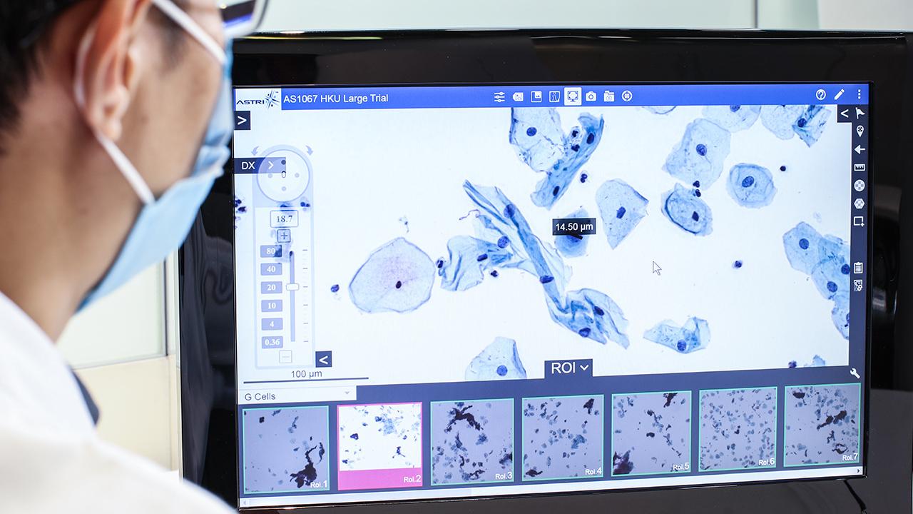 AI-aided Medical Image Analytics for  Early Cancer Screening