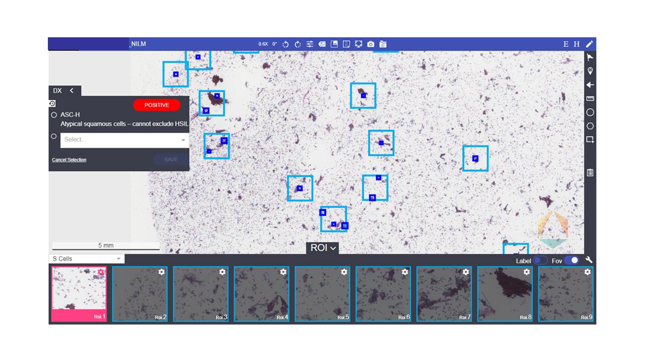 AI-aided Medical Image Analytics for  Early Cancer Screening 0