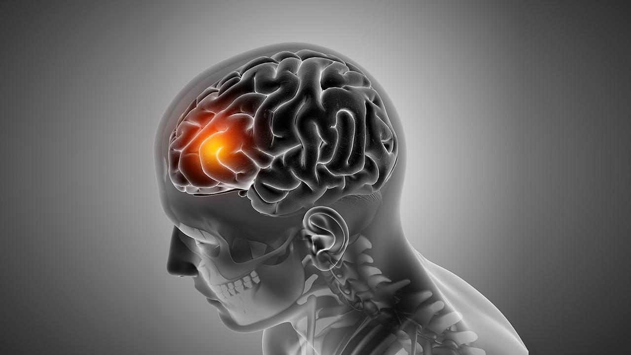 Depression subtyping