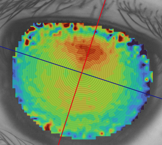 A method of calibration and reconstruction for corneal topographer 2