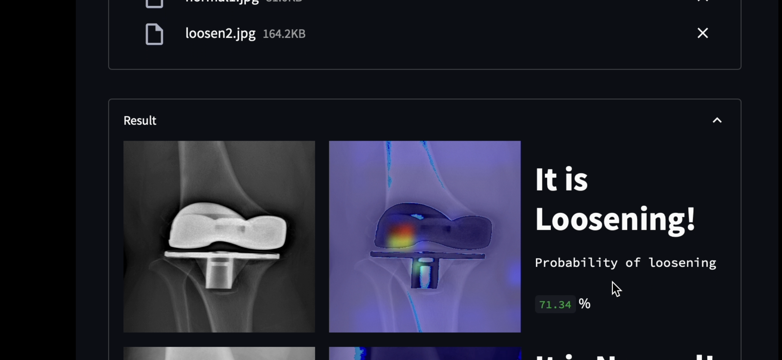 Machine Learning Algorithm for Knee Arthroplasty Loosening Detection