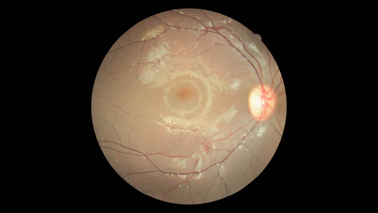 AI-based Retinal Image Analysis for the Risk of Autism and Global Developmental Delay in Preschoolers