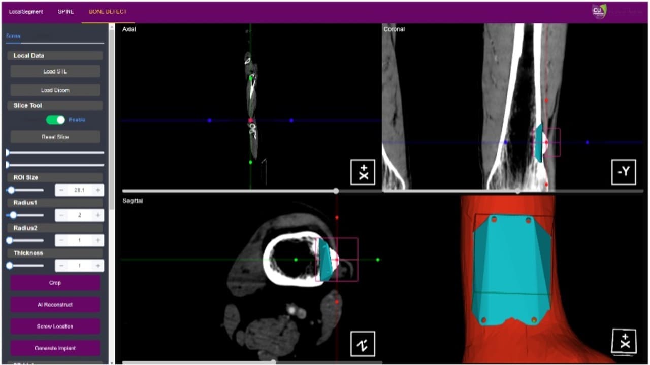 Automated Patient-Specific Prosthesis Design System for Bone Defects
