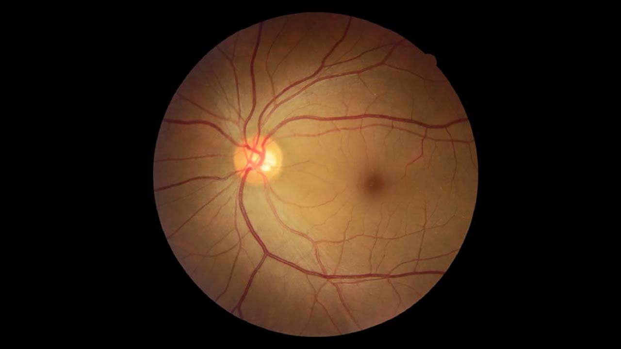 AI-based Automatic Retinal Image Analysis (ARIA) for Detecting Depression Risk in Adults